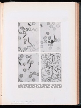 Peculiar elongated and sickle-shaped red blood corpuscles in a case of severe anemia / J.B. Herrick.