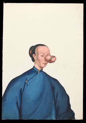 view A woman, facing to right, with a large tumour covering her left eye. Gouache, 18--, after Lam Qua, ca. 1838.