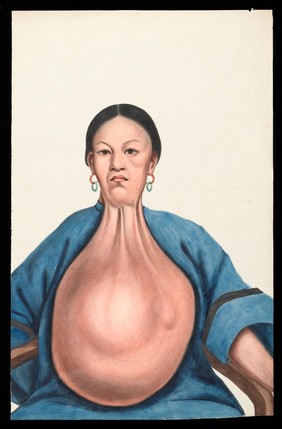 A woman (Yang She), facing front, with a massive pendent tumour hanging down from her neck. Gouache, 18--, after Lam Qua, 1837.