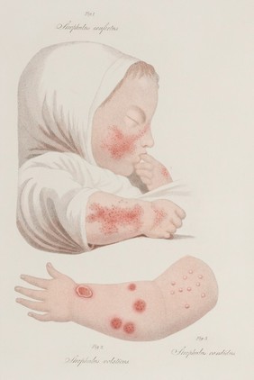 Delineations of cutaneous diseases: exhibiting the characteristic appearances of the principal genera and species comprised in the classification of the late Dr. Willan; and completing the series of engravings begun by that author / [Thomas Bateman].