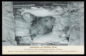 view Postcard showing conjoined twins Andenken and Emilisa Stoll