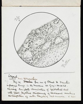 Drawing of the 1918 Influenza: Showing congestion of vessels