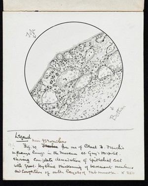 view Drawing of the 1918 Influenza: Showing congestion of vessels