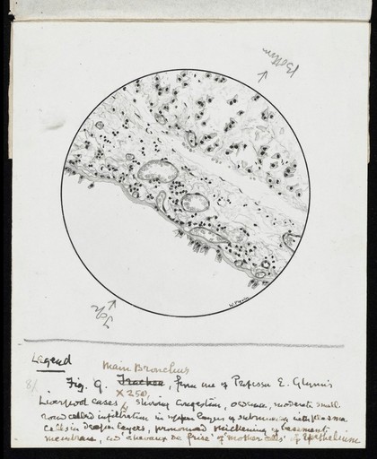 Drawing of the 1918 Influenza: Main bronchus of a set of influenza lungs in the Museum at Guy's Hospital. Showing congestion of vessels and infiltration of round cells, thickening of membrane.