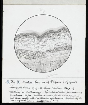 Drawing of the 1918 Influenza: Trachea showing earliest stage of reaction in influenza. Epithelium intact, but basement [?] slightly swollen as [?], with congestion and some small cells influtration of sub[?]. Hyaline deposits over epithelium