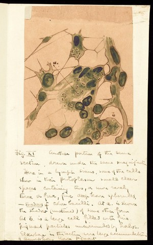 view Drawing of the 1918 Influenza: Lymph sinus, some of the cells shown in their protoplasm - small clean spaces containing two, three or four fine deep brown spherules - shadows of colon bacilli