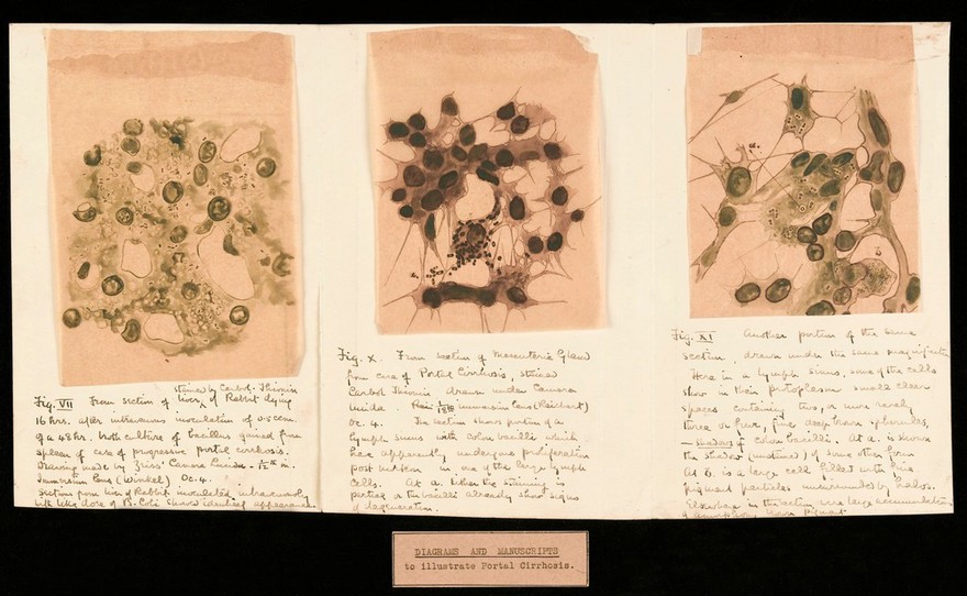 Drawing of the 1918 Influenza