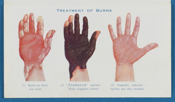 'Tannafax' brand tannic acid jelly : tannic acid, with 0.5 per cent. phenol, in a water-soluble base : the modern treatment of burns and scalds : always ready for immediate application / Burroughs Wellcome & Co. (The Wellcome Foundation Ltd.).