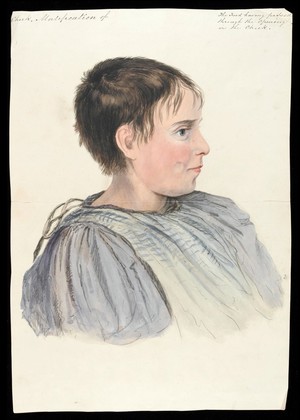 view A boy with a hole in his right cheek. Watercolour, 18--.