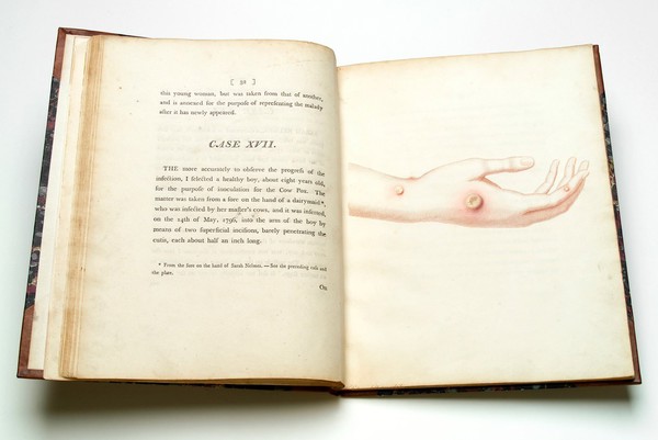 An inquiry into the causes and effects of the variolae vaccinae : a disease discovered in some of the western counties of England, particularly Gloucestershire, and known by the name of the cow pox / By Edward Jenner.