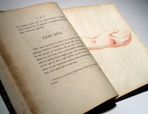 view The hand of Sarah Nelmes infected with the cowpox.