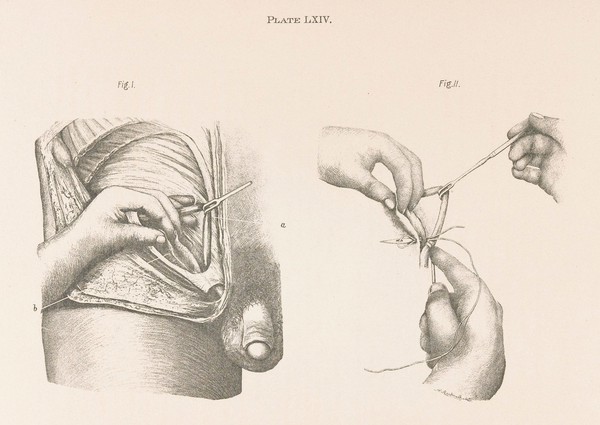 The anatomy and surgical treatment of hernia / by Henry O. Marcy.