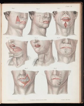 A treatise on operative surgery comprising a description of the various processes of the art, including all the new operations; exhibiting the state of surgical science in its present advanced condition; with eighty plates, containing four hundred and eighty-six separate illustrations. Second edition, revised and enlarged / by Joseph Pancoast.