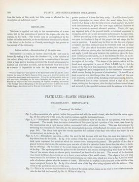 A treatise on operative surgery comprising a description of the various processes of the art, including all the new operations; exhibiting the state of surgical science in its present advanced condition; with eighty plates, containing four hundred and eighty-six separate illustrations. Second edition, revised and enlarged / by Joseph Pancoast.