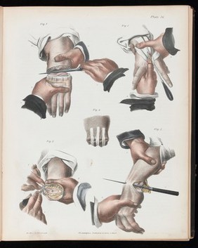 A treatise on operative surgery comprising a description of the various processes of the art, including all the new operations; exhibiting the state of surgical science in its present advanced condition; with eighty plates, containing four hundred and eighty-six separate illustrations. Second edition, revised and enlarged / by Joseph Pancoast.