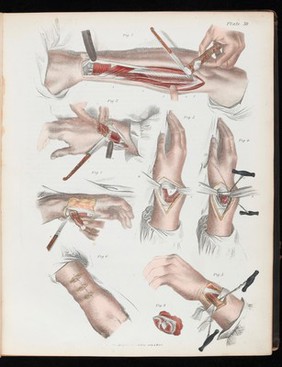 A treatise on operative surgery comprising a description of the various processes of the art, including all the new operations; exhibiting the state of surgical science in its present advanced condition; with eighty plates, containing four hundred and eighty-six separate illustrations. Second edition, revised and enlarged / by Joseph Pancoast.