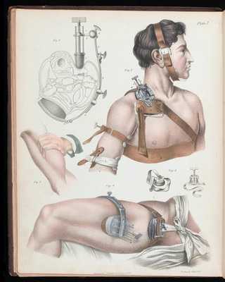 A treatise on operative surgery comprising a description of the various processes of the art, including all the new operations; exhibiting the state of surgical science in its present advanced condition; with eighty plates, containing four hundred and eighty-six separate illustrations. Second edition, revised and enlarged / by Joseph Pancoast.