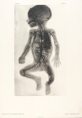 An injected arterial vessel system of a 9 month old foetus. Collotype by Römmler & Jonas after a radiograph made for G. Leopold and Th. Leisewitz, 1908.