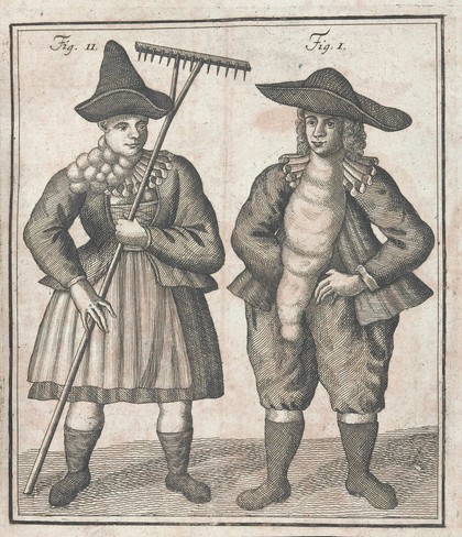 Dissertatio inauguralis medica, de strumis ac scrophulis Bünsgensium ... / [Johann Mittermayer].