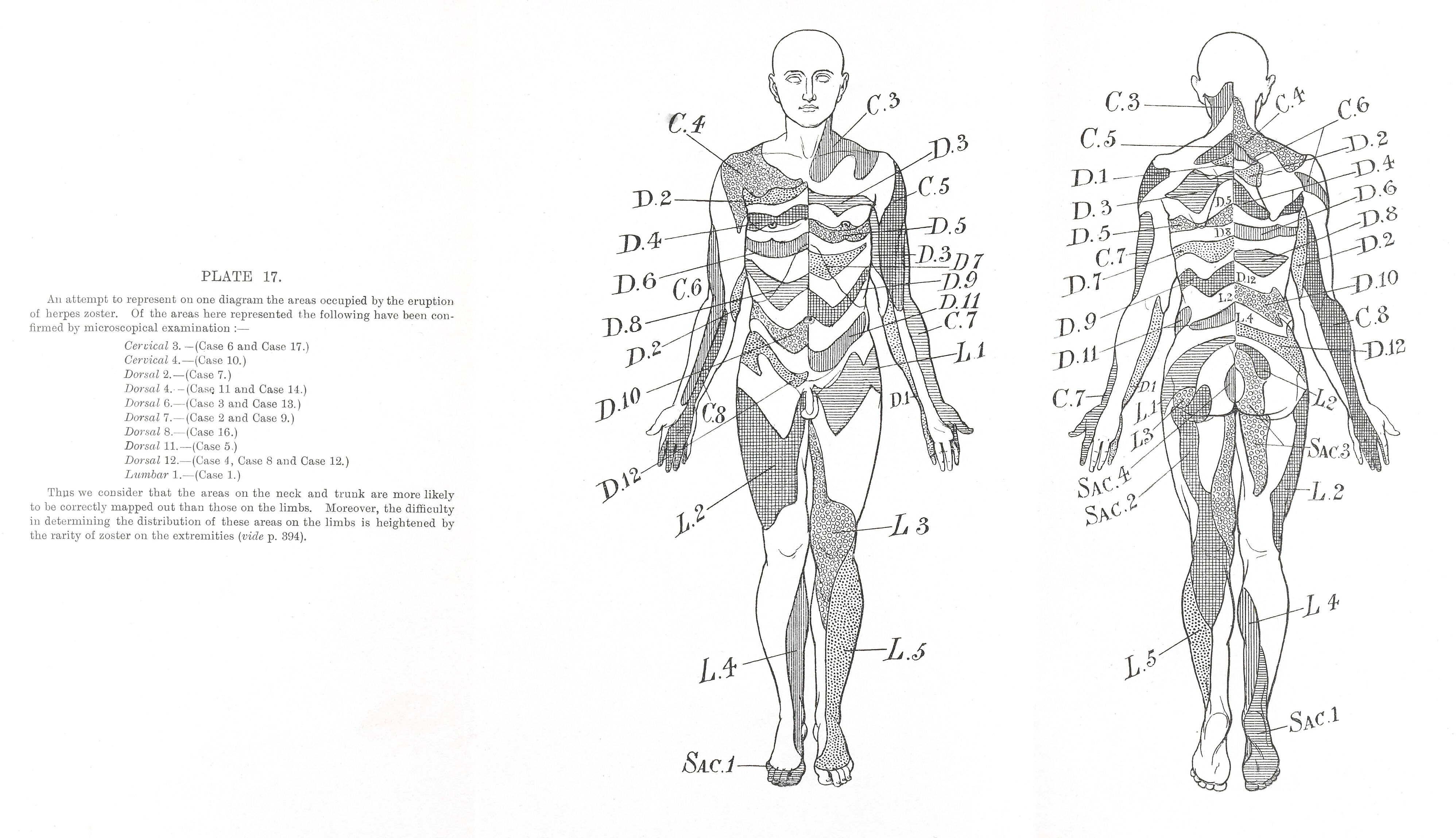 Diagram to illustrate areas of Herpes Zoster eruption Collection
