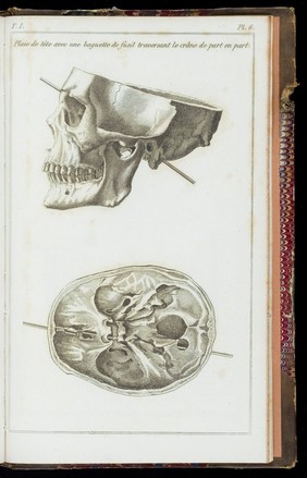 Clinique chirurgicale : exercée particulièrement dans les camps et les hopitaux militaires, depuis 1792 jusqu'en 1829 [1832,1836] / par le baron D.J. Larrey.