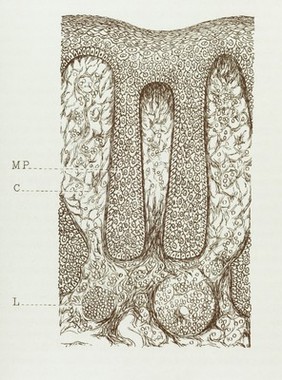 M0001058: Drawing showing a caesarean operation taking place in Uganda / M0001059: Drawing of a woman's torso after a caesarean operation