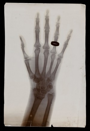 view The bones of the hand of Mrs F. Bridgeman, wearing a finger ring, showing a broken wrist. Photograph of X-ray, 1911.