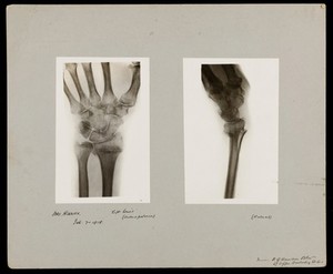 view The bones of the wrist of Mrs Herries: two views. Photograph of X-ray by G. Harrison Orton, 1918.