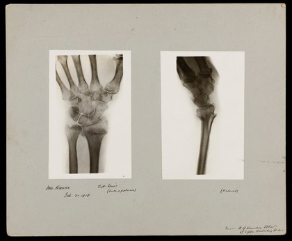 The bones of the wrist of Mrs Herries: two views. Photograph of X-ray by G. Harrison Orton, 1918.