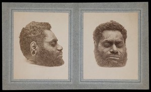 view The decapitated head of a man: two views. Photographs, 18--.