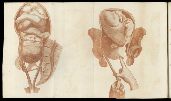 A system of obstetrical tables, with explanations; representing the foundations of the theory and practice of midwifery / [John Aitken].