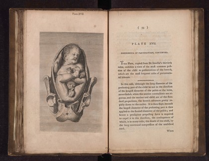 A collection of engravings designed to facilitate the study of midwifery, explained and illustrated / [James Hamilton].