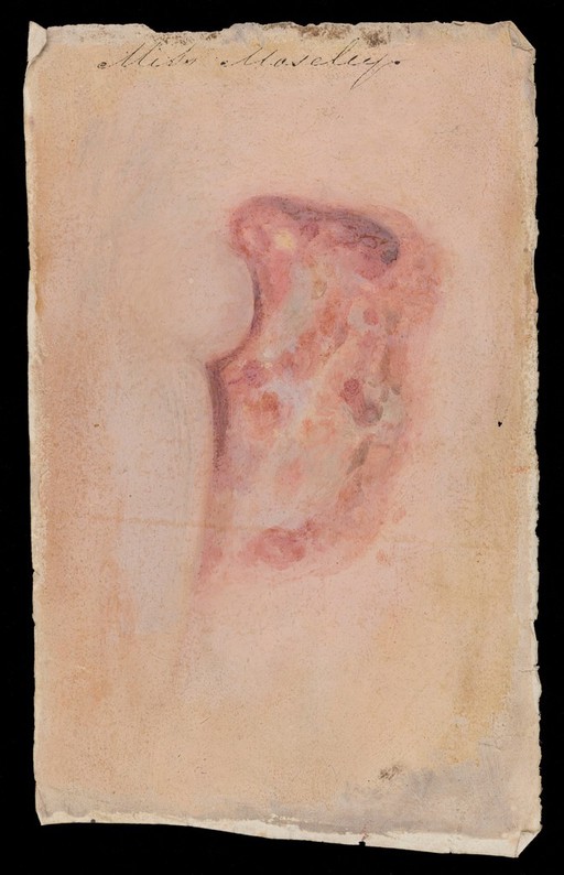 Miss Mosley, afflicted with breast cancer: detail of cancer