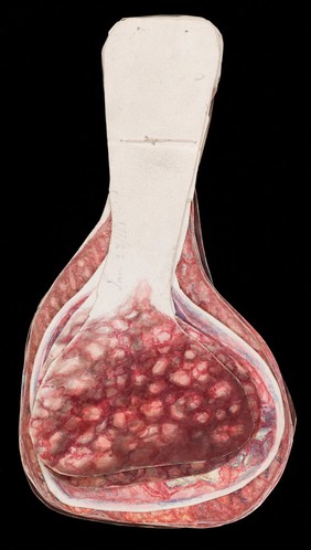 Mrs Broadbent, afflicted with breast cancer. Watercolour, 1840.