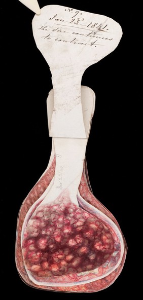Mrs Broadbent, afflicted with breast cancer. Watercolour, 1840.
