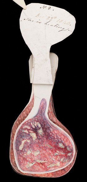 Mrs Broadbent, afflicted with breast cancer. Watercolour, 1840.
