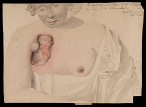 view Miss Mosley, afflicted with breast cancer. Watercolour, 1828.