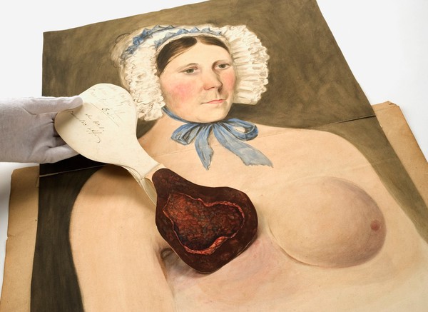 Stages in breast cancer suffered by Mrs Broadbent of Leeds. Watercolours, 1840-1841.
