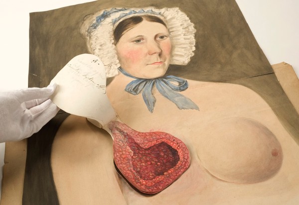 Stages in breast cancer suffered by Mrs Broadbent of Leeds. Watercolours, 1840-1841.