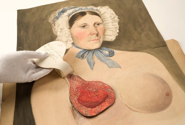 Stages in breast cancer suffered by Mrs Broadbent of Leeds. Watercolours, 1840-1841.