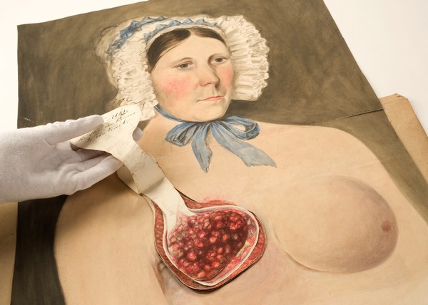 Stages in breast cancer suffered by Mrs Broadbent of Leeds. Watercolours, 1840-1841.