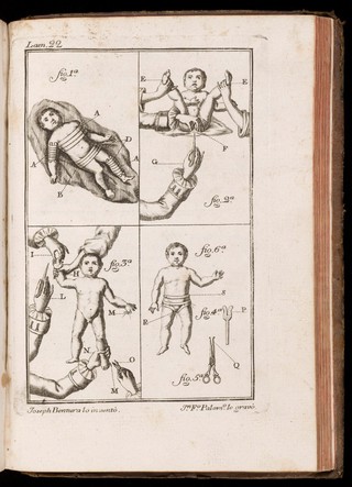 Preceptos generales sobre las operaciones de los partos : este tratado es una exposicion completa del arte obstetrice, en el qual se explican con la mayor especies de partos : esta adicionado con advertencias y notas de lo mejor que han escrito los profesores modernos : ilustrado con observaciones prácticas muy instructivas, y adornado con láminas finas : escrito particularmente para la instruccion de los cirujanos partidarios / Don Joseph Ventura Pastor.