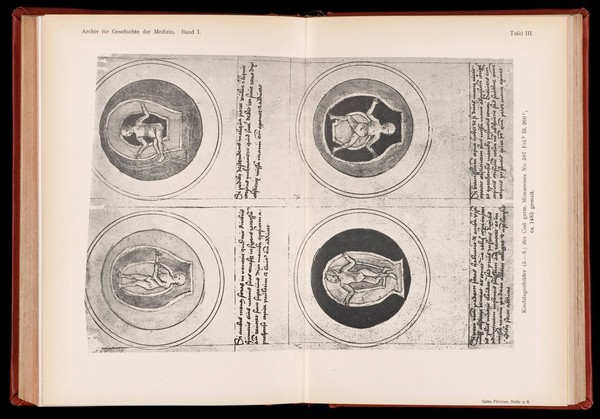 Neue Handschriftenbilder von Kindslagen und der Situs einer Schwangeren vom Jahre 1485 / von Karl Sudhoff.