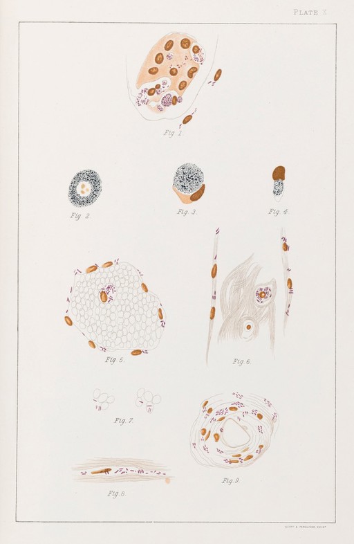 Illustration of cells infected with Leprosy bacilli.