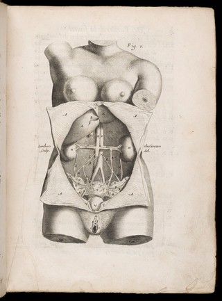 Des maladies des femmes grosses et accouchées. Avec la bonne et veritable méthode de les bien aider en leurs accouchemens naturels, & les moyens de remedier à tous ceux qui sont contre-nature, & aux indispositions des enfans nouveau-nés: ensemble une tres-exacte description de toutes les parties de la femme qui sont destinées à la generation ... / composé par François Mauriceau maistre chirurgien iuré à Paris.