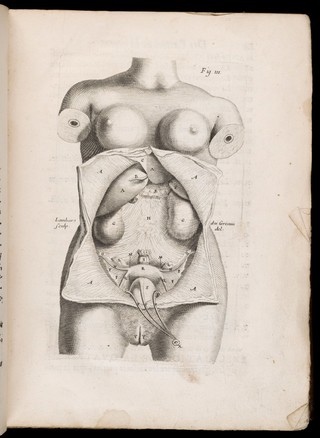 Des maladies des femmes grosses et accouchées. Avec la bonne et veritable méthode de les bien aider en leurs accouchemens naturels, & les moyens de remedier à tous ceux qui sont contre-nature, & aux indispositions des enfans nouveau-nés: ensemble une tres-exacte description de toutes les parties de la femme qui sont destinées à la generation ... / composé par François Mauriceau maistre chirurgien iuré à Paris.