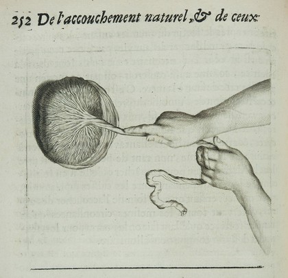 Des maladies des femmes grosses et accouchées. Avec la bonne et veritable méthode de les bien aider en leurs accouchemens naturels, & les moyens de remedier à tous ceux qui sont contre-nature, & aux indispositions des enfans nouveau-nés: ensemble une tres-exacte description de toutes les parties de la femme qui sont destinées à la generation ... / composé par François Mauriceau maistre chirurgien iuré à Paris.