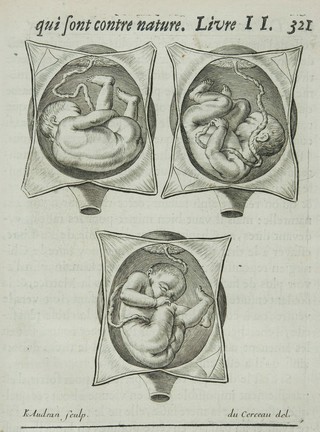 Des maladies des femmes grosses et accouchées. Avec la bonne et veritable méthode de les bien aider en leurs accouchemens naturels, & les moyens de remedier à tous ceux qui sont contre-nature, & aux indispositions des enfans nouveau-nés: ensemble une tres-exacte description de toutes les parties de la femme qui sont destinées à la generation ... / composé par François Mauriceau maistre chirurgien iuré à Paris.