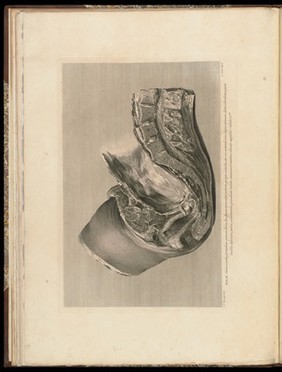 Anatomia uteri humani gravidi tabulis illustrata ... The anatomy of the human gravid uteris exhibited in figures / [William Hunter].