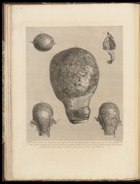 Anatomia uteri humani gravidi tabulis illustrata ... The anatomy of the human gravid uteris exhibited in figures / [William Hunter].